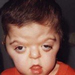 sindrome de turner